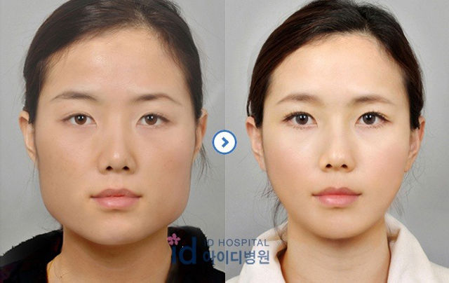 before_and_after_photos_of_korean_plastic_surgery_part_2_640_53.jpg