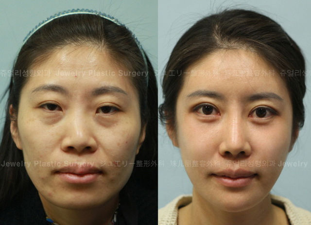 before_and_after_photos_of_korean_plastic_surgery_part_2_640_54.jpg