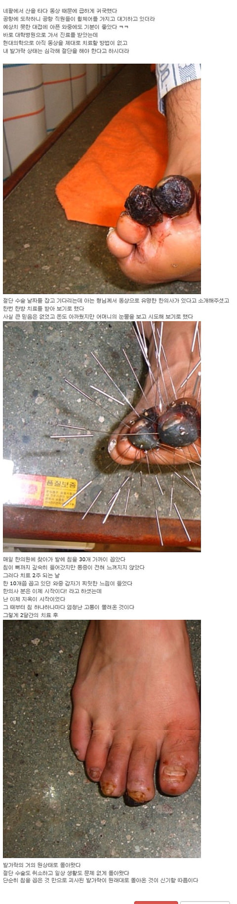 약혐일수도?)베스트간 침술로 괴사 치료하는짤이 웃긴점.jpg_1.jpg