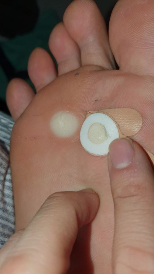 혐)티눈밴드 많이써본 유게이있냐_2.jpg