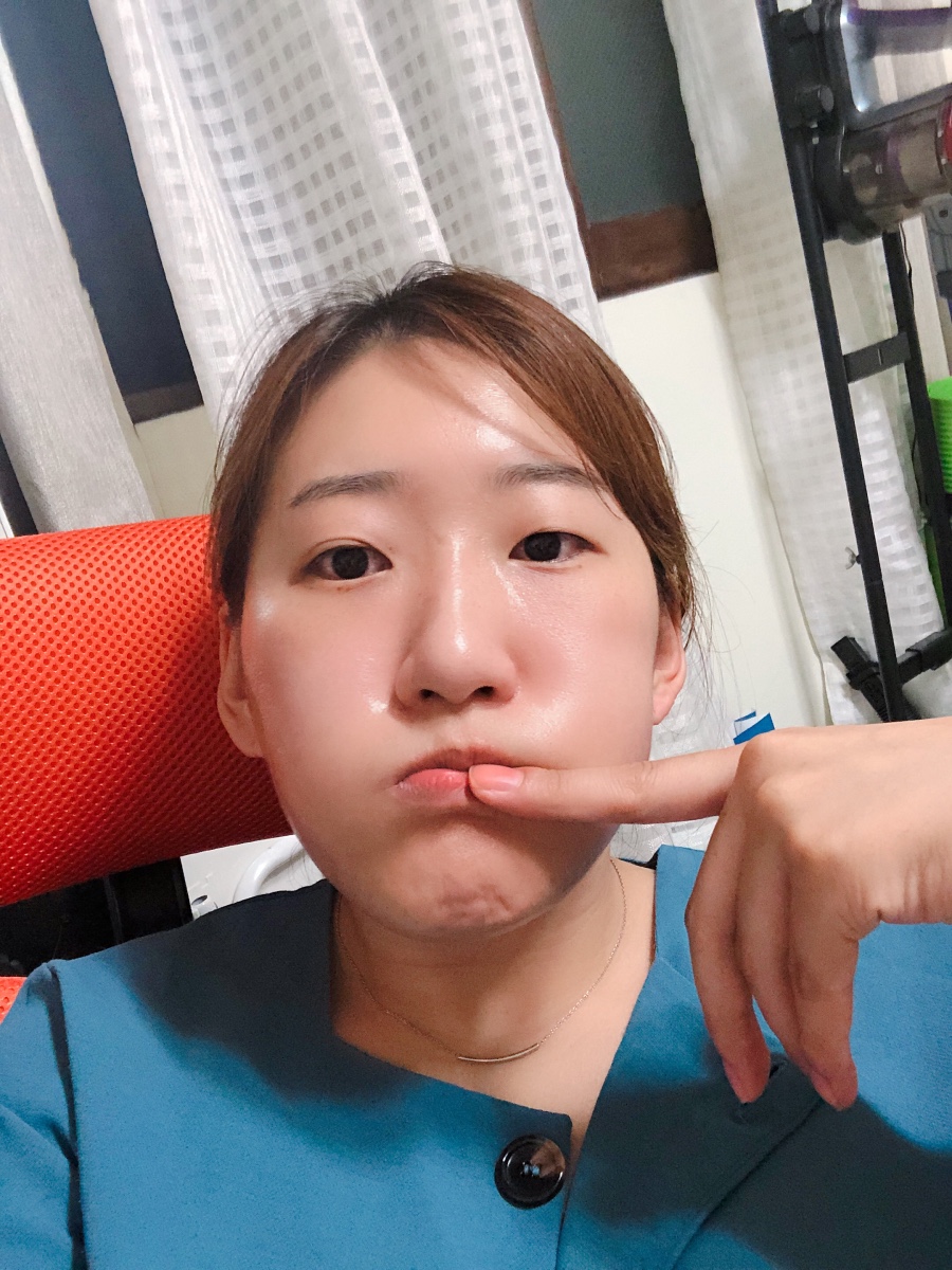 양악수술 후 곧 8개월차 전후비교