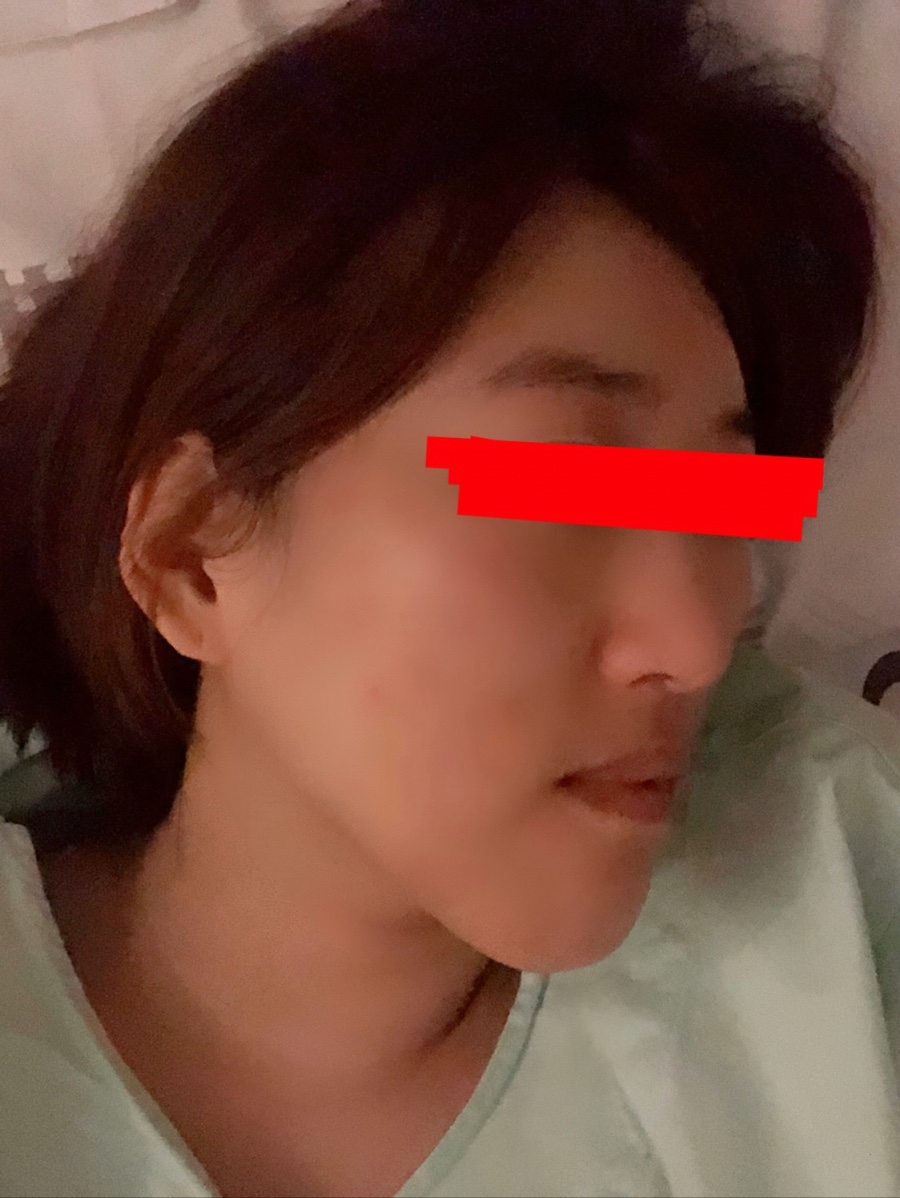 양악수술 후 곧 8개월차 전후비교