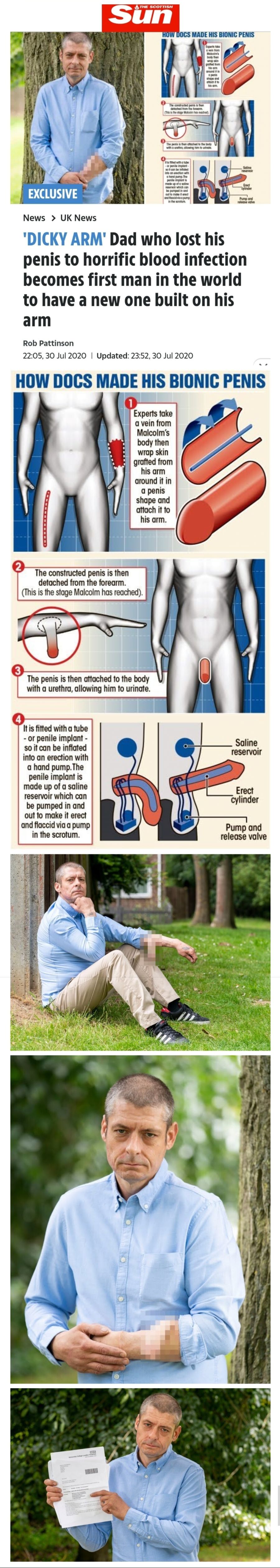 팔에 인공 쥬지를 달고 다니는 남자 ㄷㄷㄷ_2.jpg