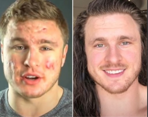 중증이상 여드름에 가장 좋은것(투표좀)_1.jpg