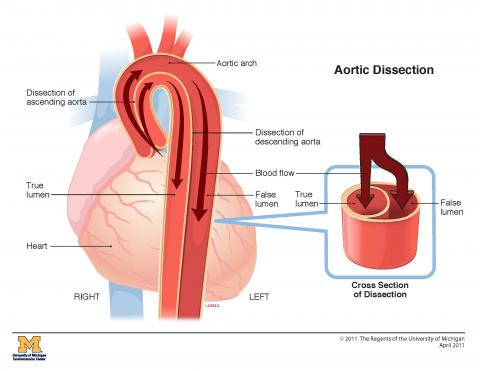 cs-aortic-dissection.jpg