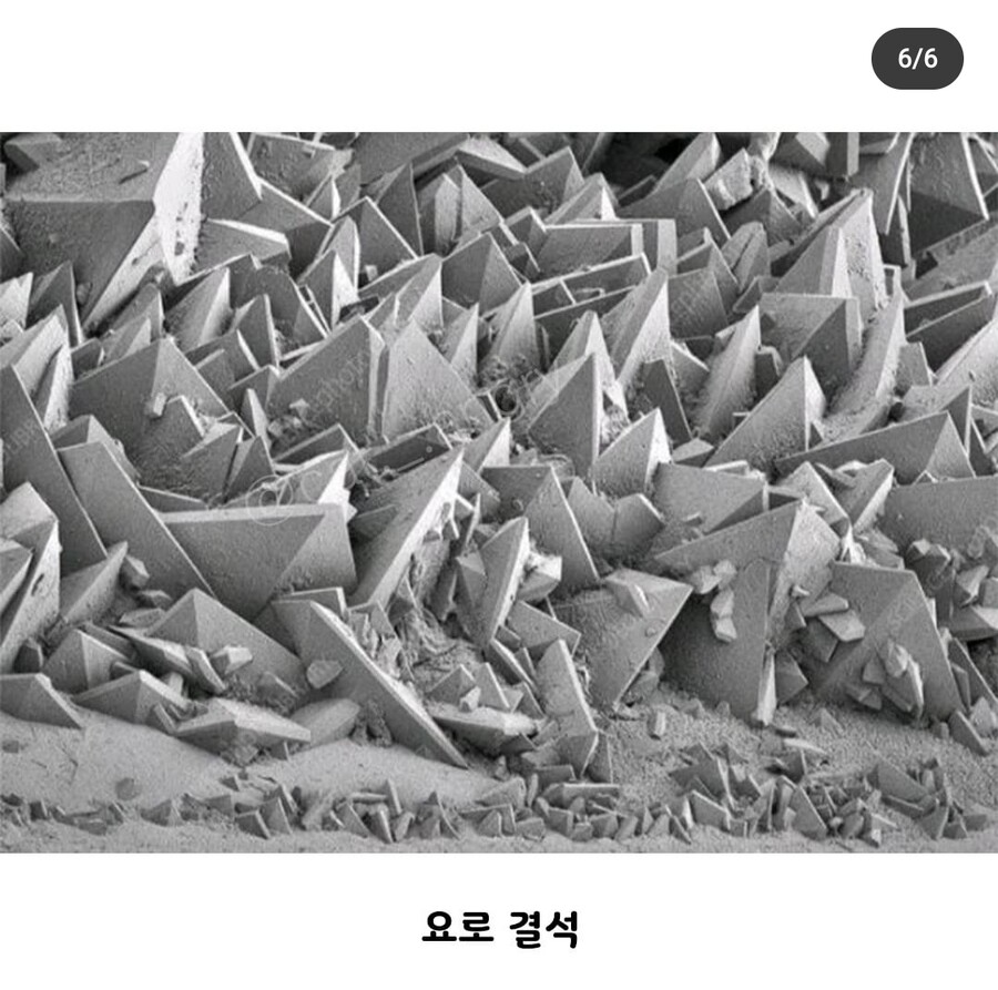 요로결석이 아픈이유
