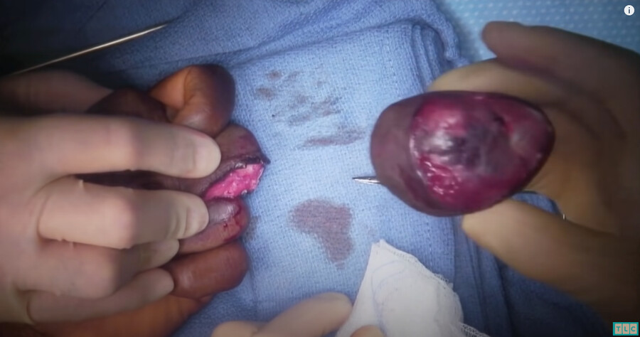 혐오) 손가락에 자라난 혹 제거 영상 보고 있는데_2.png