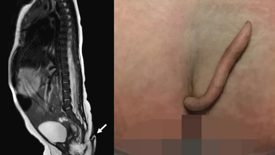 [멕시코] 꼬리 달고 태어난 아기_1.png