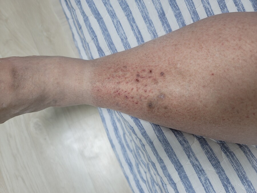 100키로 넘는 돼지새끼인데 종아리 쪽 피부 때문에 물어볼게 있어용._1.jpg