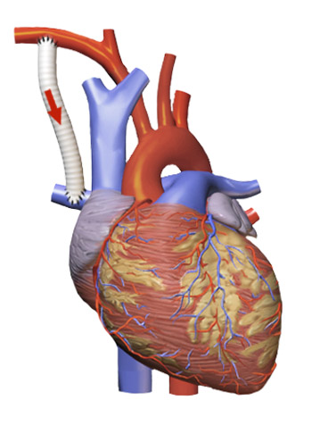 Blalock_Taussig_Shunt_-_Aortic_to_Pulmonary.png