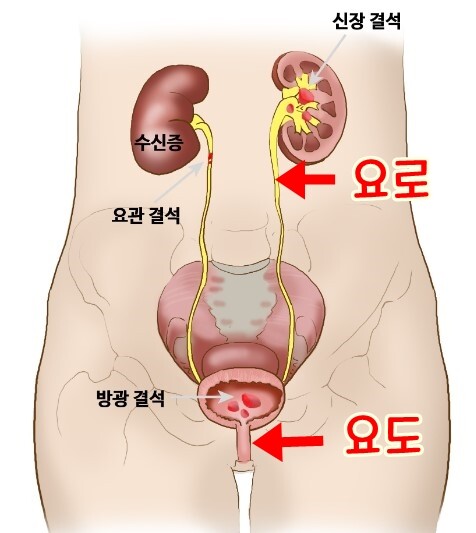베스트 요로결석 만화보고 하나 짚고 넘어가는거