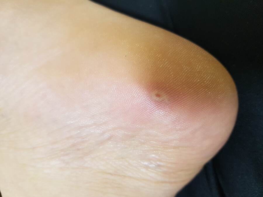 혐오)얘들아 이거 티눈임? 사마귀임? 물집임?_1.jpg