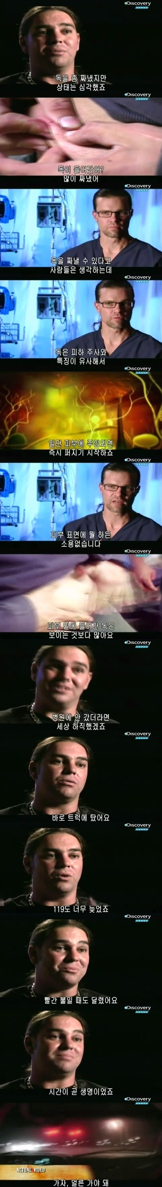 [극혐] 코브라한테 물려서 몸에 구멍이 생긴 남자.jpg_4.jpg