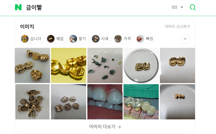 금이빨 은이빨 차이_1.png