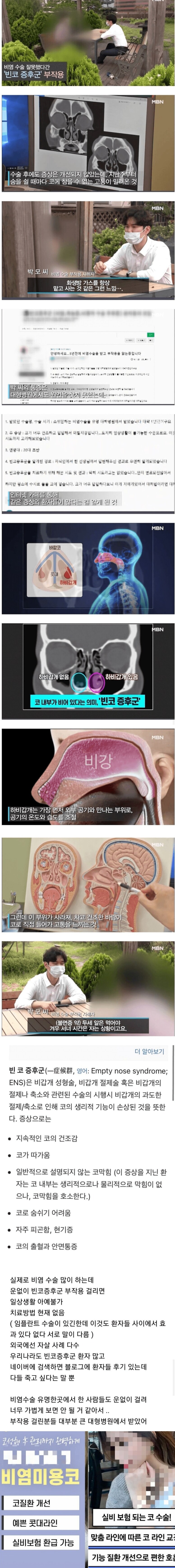 자살한 사례까지 생긴다는 비염수술 부작용 '빈코증후군'_1.jpg