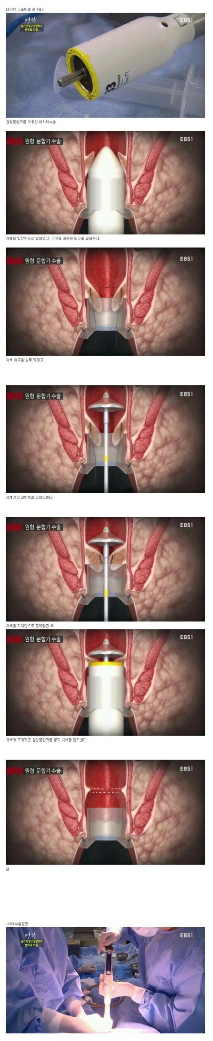 환자 똥꼬 닦아주다가 PPH장비가 쑥 들어갔는데_1.jpg