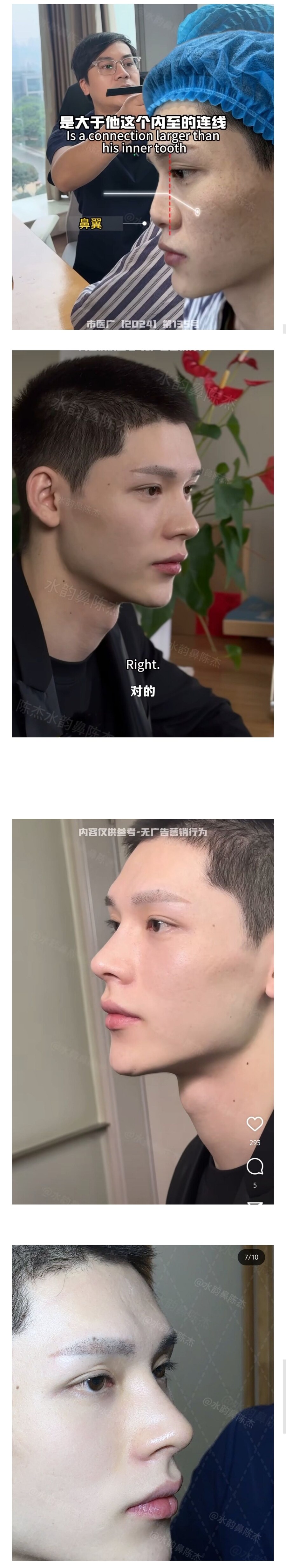 남자 코수술 레전드_1.jpg