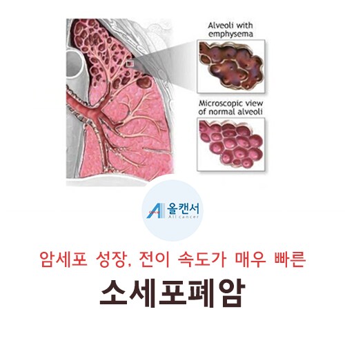 현재 난리났다는 소세포폐암 암억제 연구 근황 ㅎㄷㄷㄷㄷ_2.png