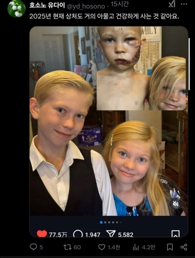 동생을 개로부터 구한 오빠 근황_2.jpg