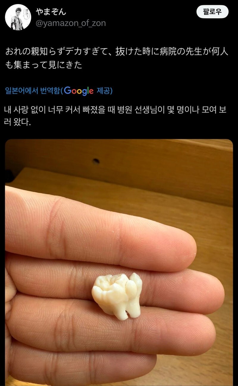 치과의사들: 이건 꼭구경 해야하는 사랑니다!!_1.jpg