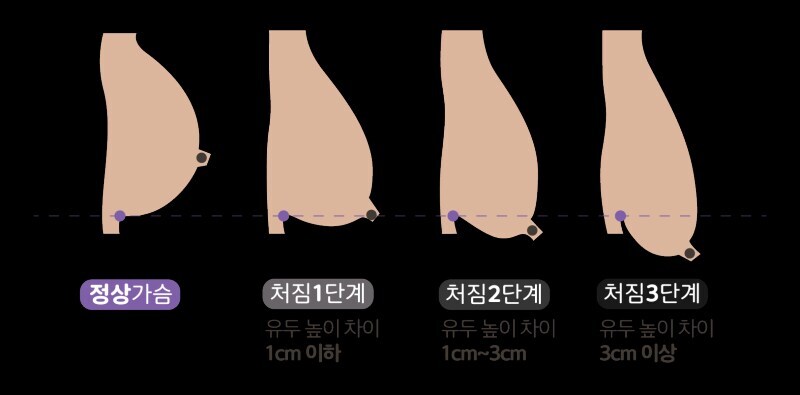 ㅂㄹ 가슴이라는 안 좋은 단어보다_1.jpg