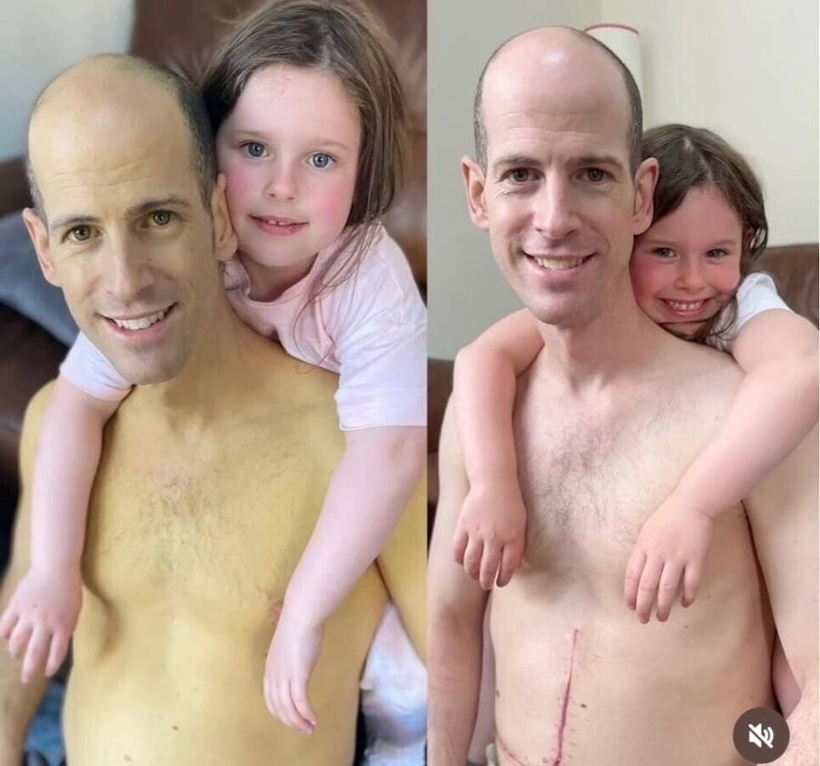 간이식 전 vs 간이식 후_1.jpg