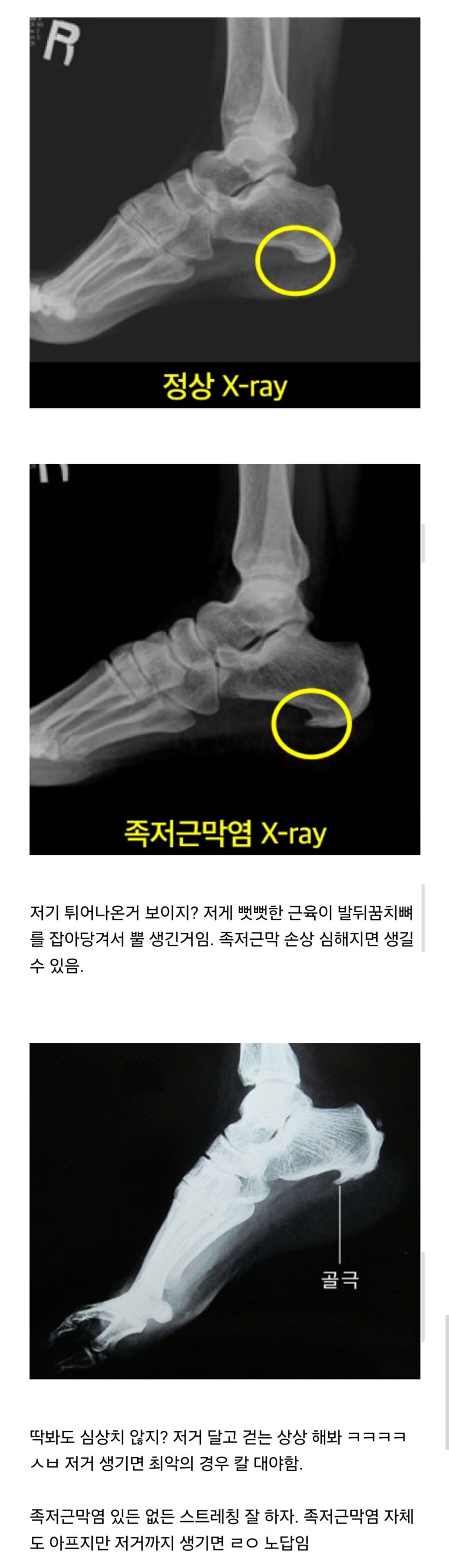 족저근막염 내버려두면 발바닥에 뿔도 생김_1.jpg
