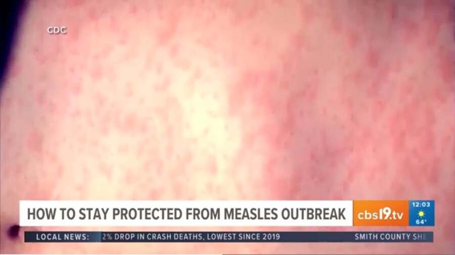 미국 텍사스에서 유행중이라는 '홍역파티'_1.jpg