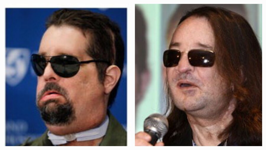 페이스 오프 수술 전후(혐짤있음)_2.jpg