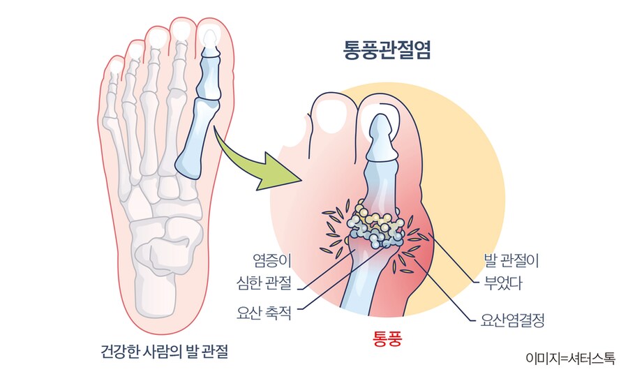 혐)통풍의 메커니즘_2.png