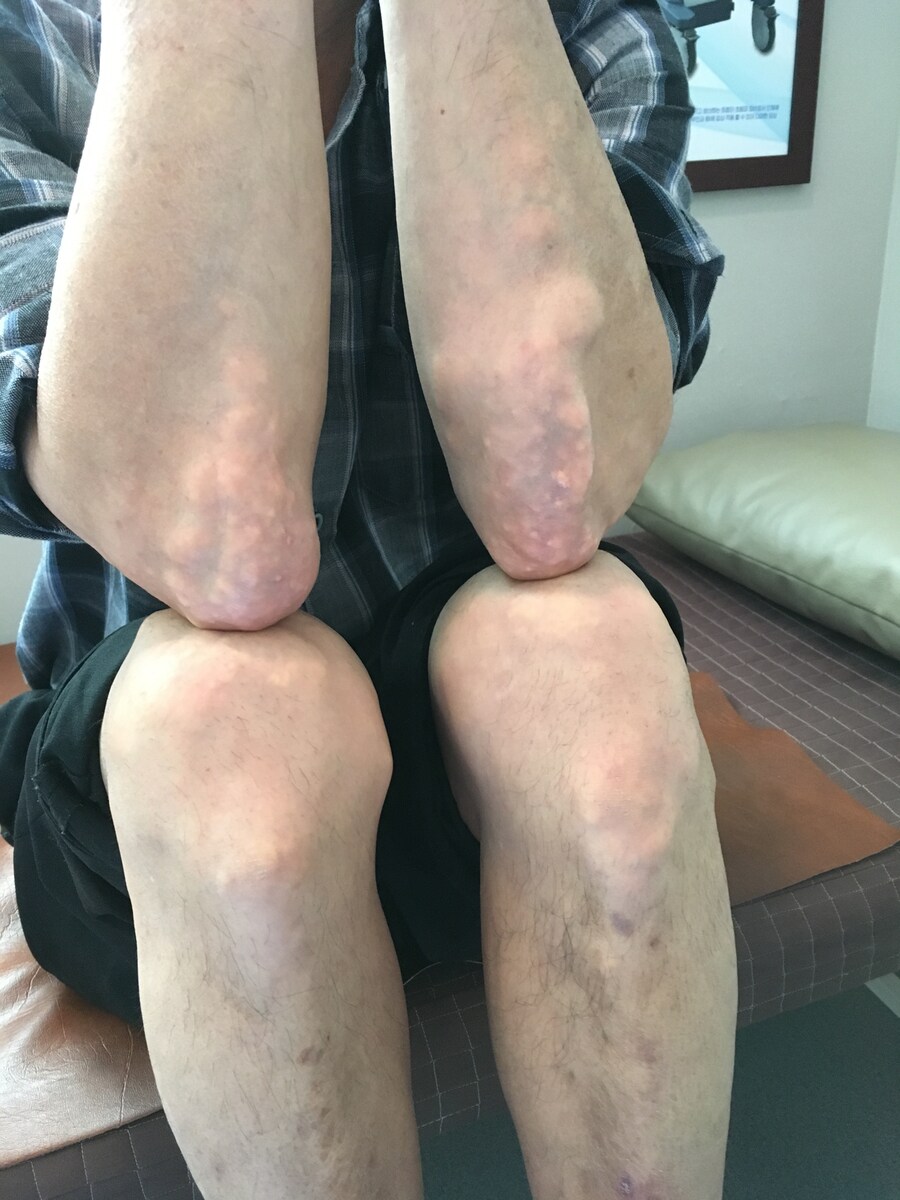 혐)통풍의 메커니즘_3.png