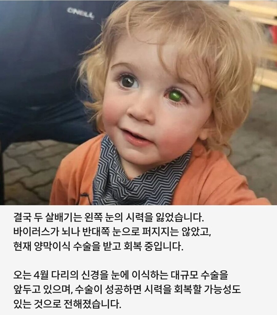 뽀뽀받고 실명해버린 만1세 아기_4.jpg