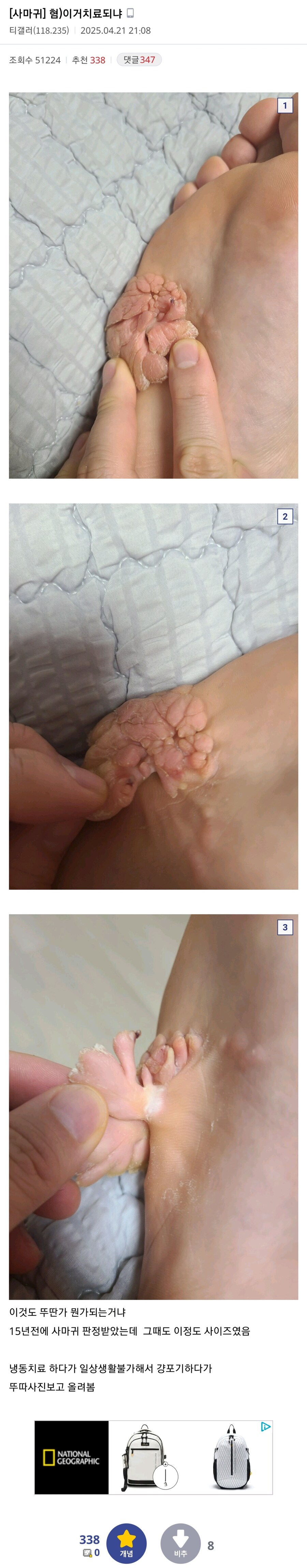 [혐]공포의 티눈갤러리.jpeg_2.jpg