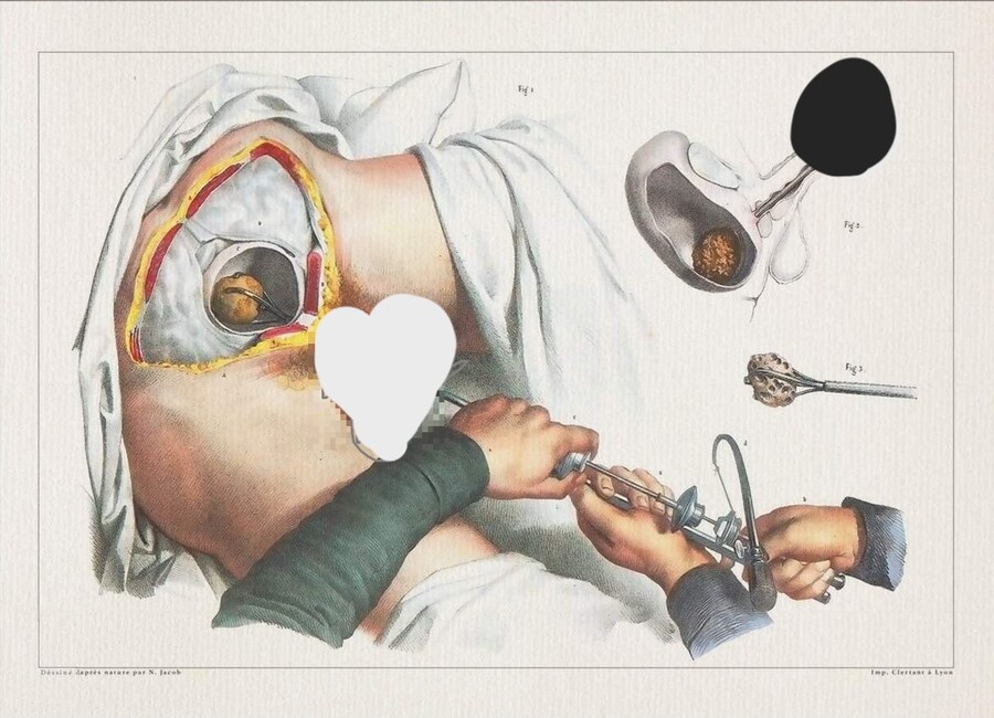 옛날 요로결석환자들은 어떻게살았을까_1.jpg