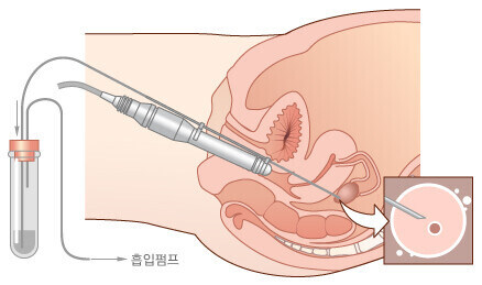 정액 착정보다 무서운 '난자채취'