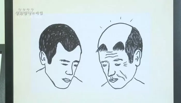 이 모발이식 짤 보니까 생각난건데_1.webp