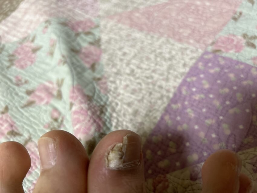 혐) 내성발톱 모음_6.jpg