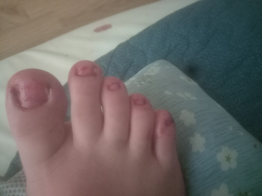 혐) 내성발톱 모음_4.jpg