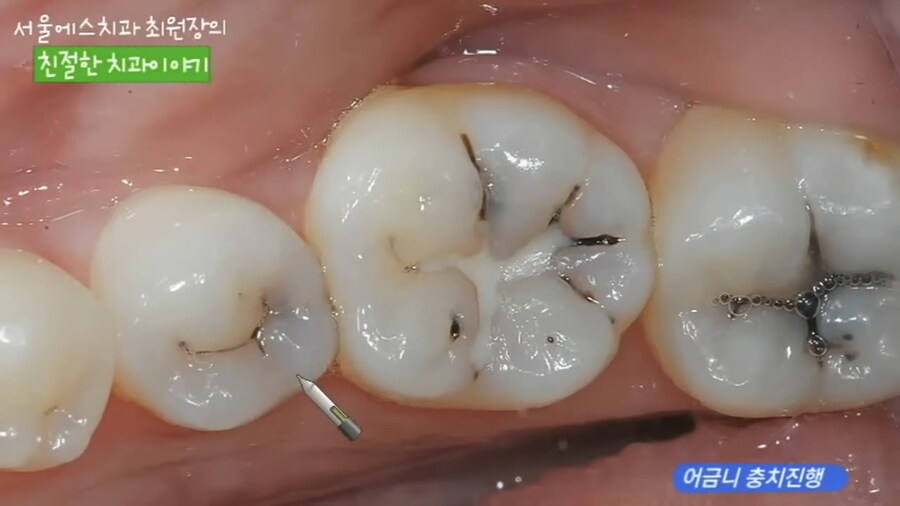 충치 치료 과정.jpg_1.jpg