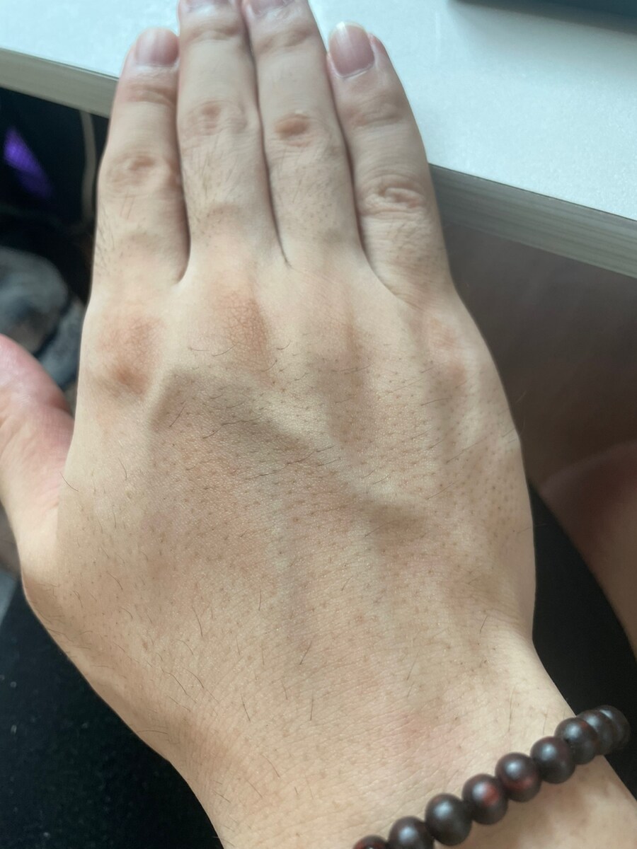 팔,손털 제모했는데 더 더럽게 나는데 왜이럼??_2.jpg