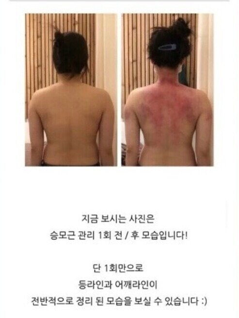 승모근 교정 후기._1.png