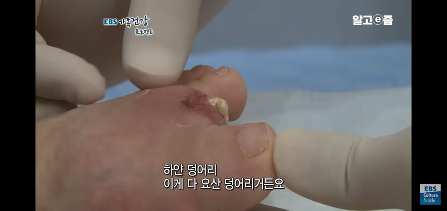 통풍 위험군 유게이들을 위한 건강정보_1.jpg