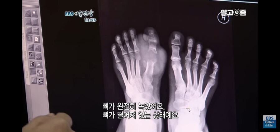통풍 위험군 유게이들을 위한 건강정보_2.jpg