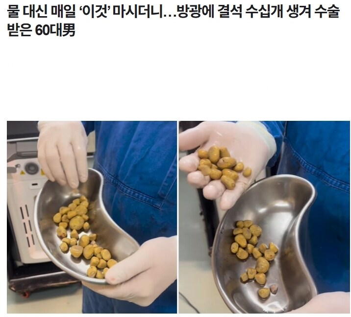 유게 요로결석 썰은 약과다_1.jpg