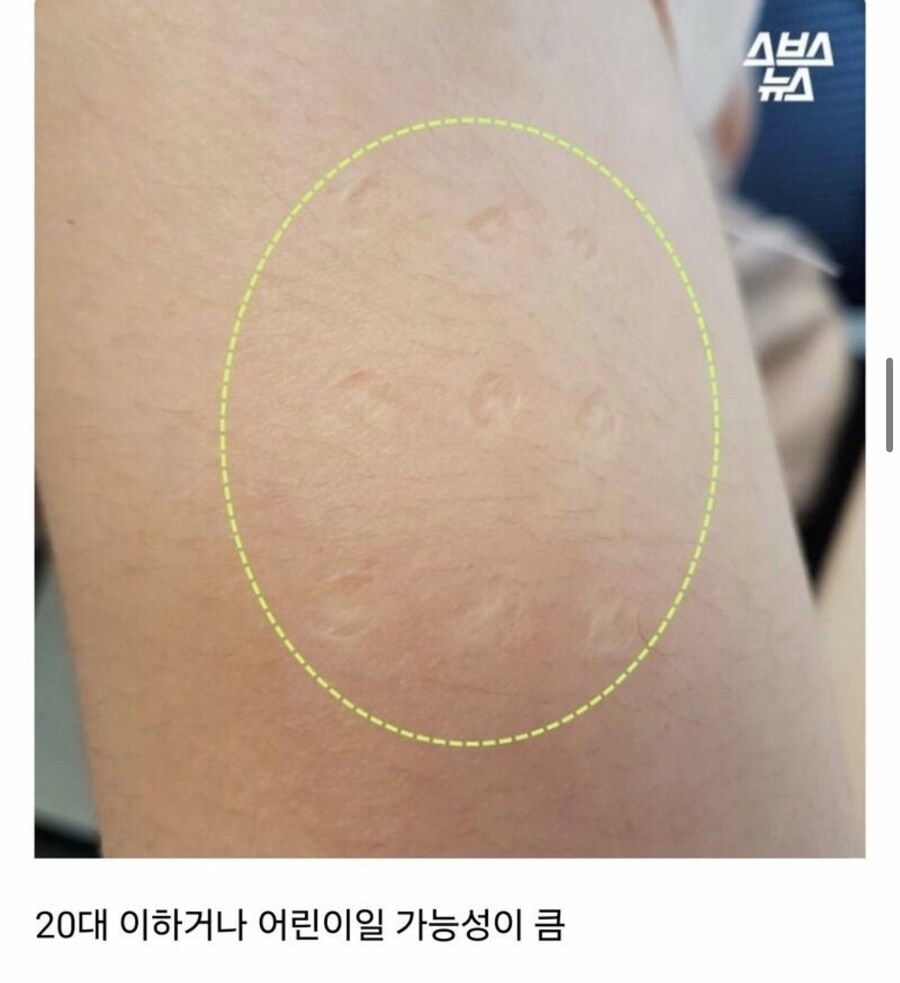 나잇대로 알수 있는 흉터들_4.jpg