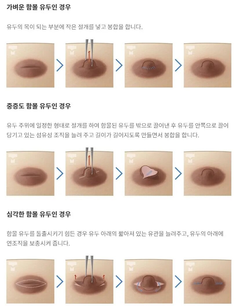 유두 시술법_2.jpg