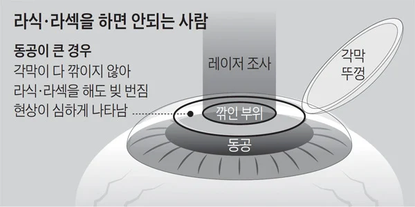 부작용이 있다 없다로 계속해서 논란인 수술_2.webp