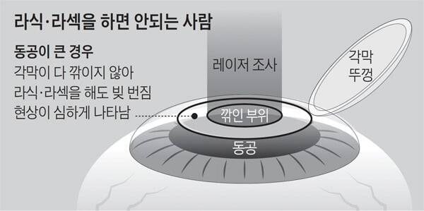 부작용 있다 없다로 30년째 논란인 수술_2.jpg