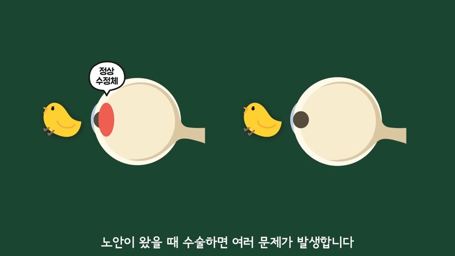 안과 의사들이 안경을 쓰는 이유.jpg_14.png