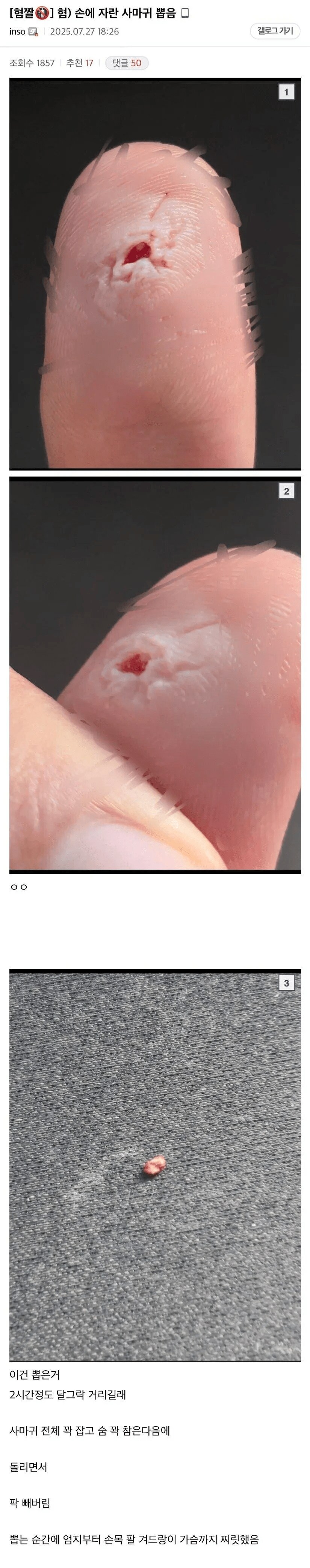 혐) 손에 자란 사마귀 뽑음_1.png